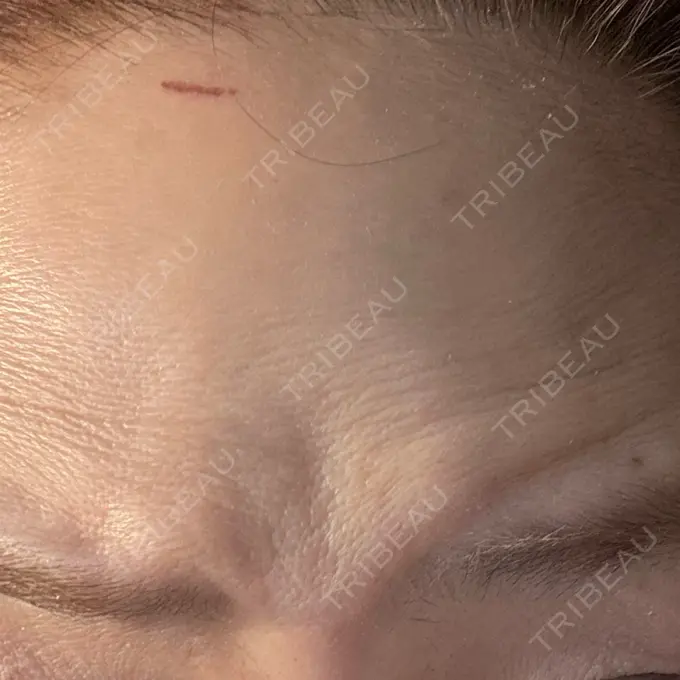 ボトックス（目尻） / ボトックス（額） 湘南美容クリニック 大阪梅田本院 AFTER メイン用