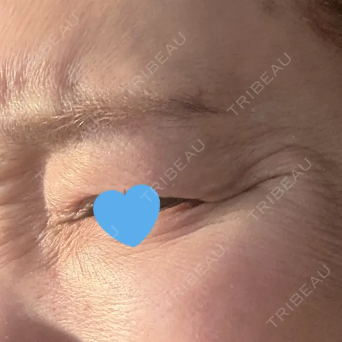 ボトックス（目尻） / ボトックス（額） 湘南美容クリニック 大阪梅田本院 DAY 4 メイン用