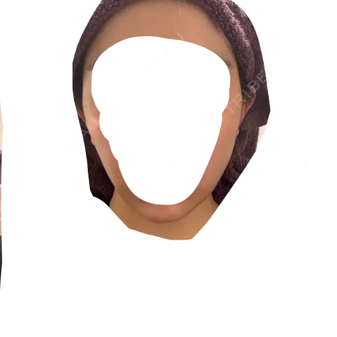 ハイフ（顔） / RF（高周波）たるみ治療 表参道メディカルクリニック 表参道院 AFTER メイン用