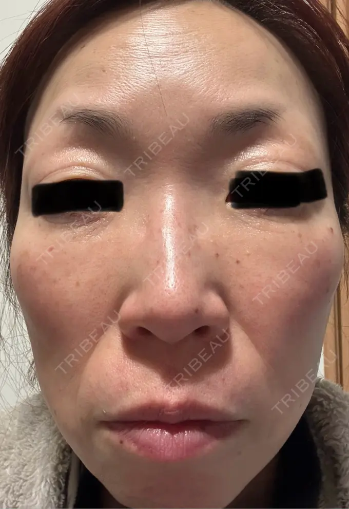 ピーリング（ハリ・ツヤ） 椿クリニック 名古屋院 DAY 5 メイン用