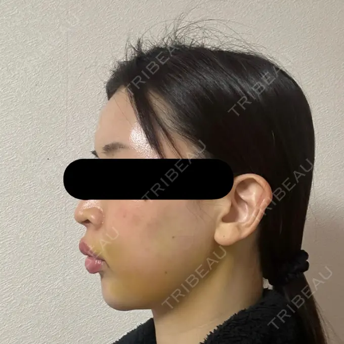 糸リフト / バッカルファット除去 / 脂肪吸引（顔） / ジョールファット除去 / ヒアルロン酸注入（額） / ヒアルロン酸注入（頬） BLINC CLINIC （ブリンク クリニック） DAY 5 メイン用