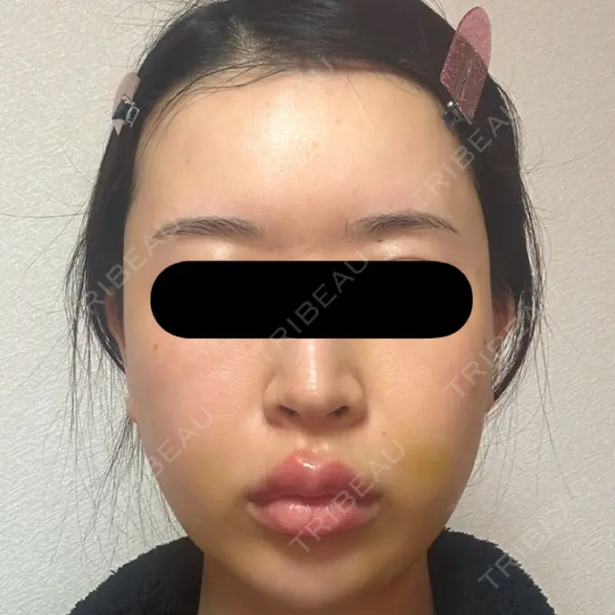 糸リフト / バッカルファット除去 / 脂肪吸引（顔） / ジョールファット除去 / ヒアルロン酸注入（額） / ヒアルロン酸注入（頬） BLINC CLINIC （ブリンク クリニック） DAY 9 メイン用