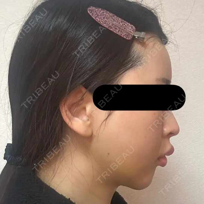 糸リフト / バッカルファット除去 / 脂肪吸引（顔） / ジョールファット除去 / ヒアルロン酸注入（額） / ヒアルロン酸注入（頬） BLINC CLINIC （ブリンク クリニック） DAY 9 メイン用