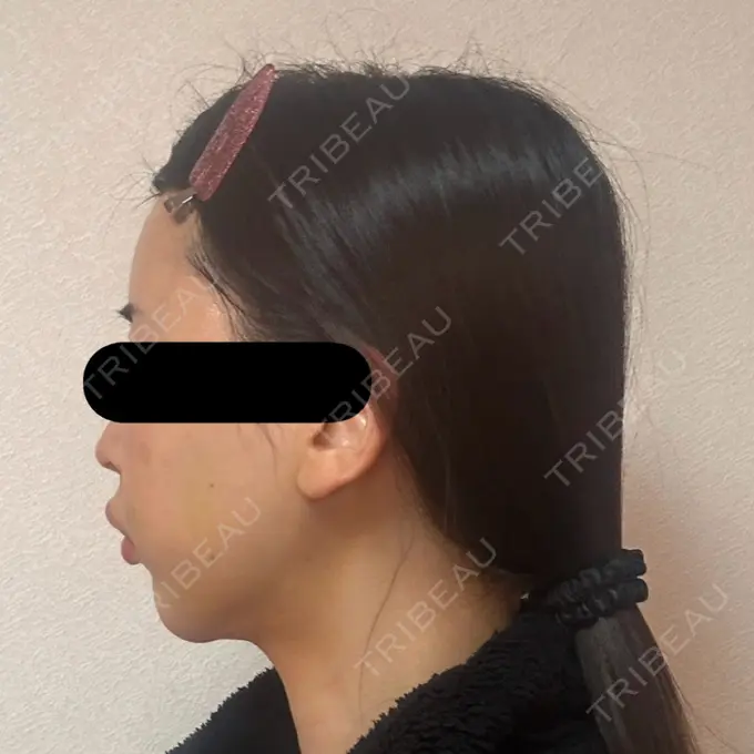 糸リフト / バッカルファット除去 / 脂肪吸引（顔） / ジョールファット除去 / ヒアルロン酸注入（額） / ヒアルロン酸注入（頬） BLINC CLINIC （ブリンク クリニック） DAY 9 メイン用