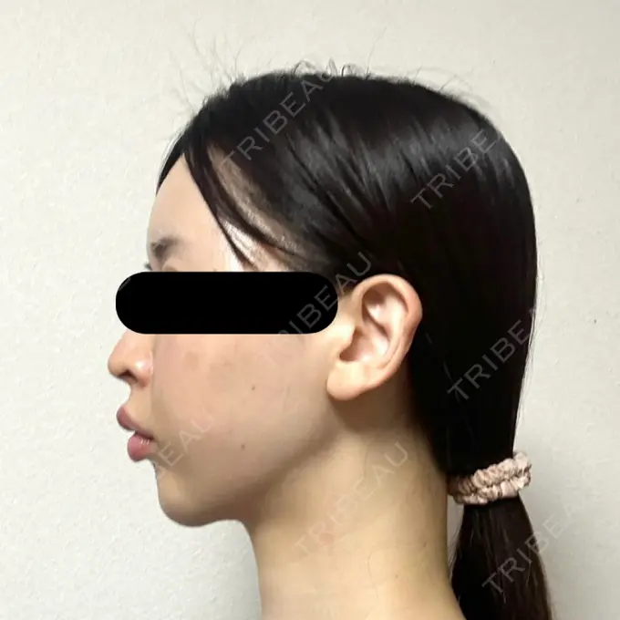 糸リフト / バッカルファット除去 / 脂肪吸引（顔） / ジョールファット除去 / ヒアルロン酸注入（額） / ヒアルロン酸注入（頬） BLINC CLINIC （ブリンク クリニック） DAY 30 メイン用