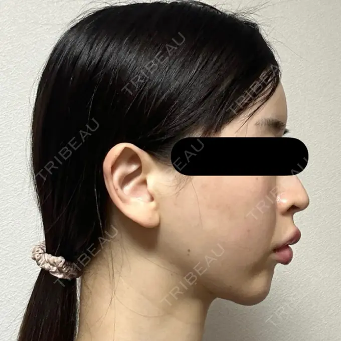 糸リフト / バッカルファット除去 / 脂肪吸引（顔） / ジョールファット除去 / ヒアルロン酸注入（額） / ヒアルロン酸注入（頬） BLINC CLINIC （ブリンク クリニック） DAY 30 メイン用