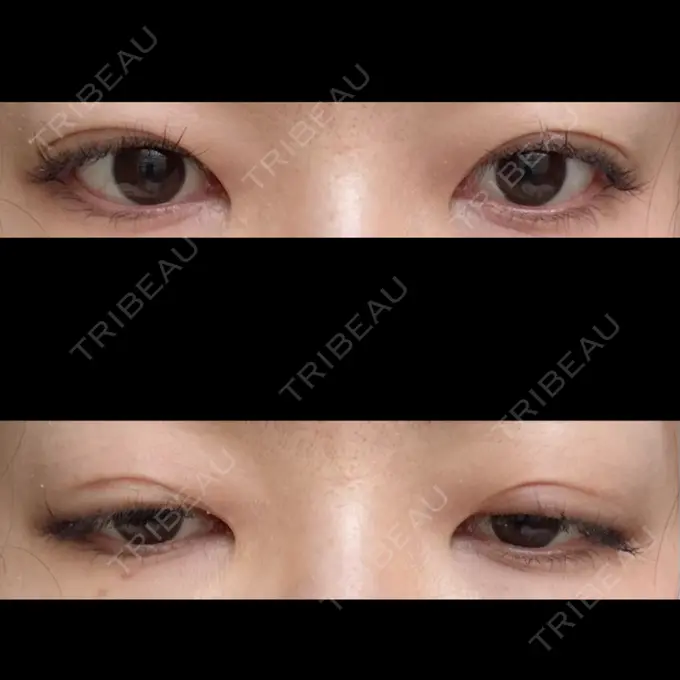 二重埋没 水の森美容クリニック 東京銀座院 DAY 20 メイン用