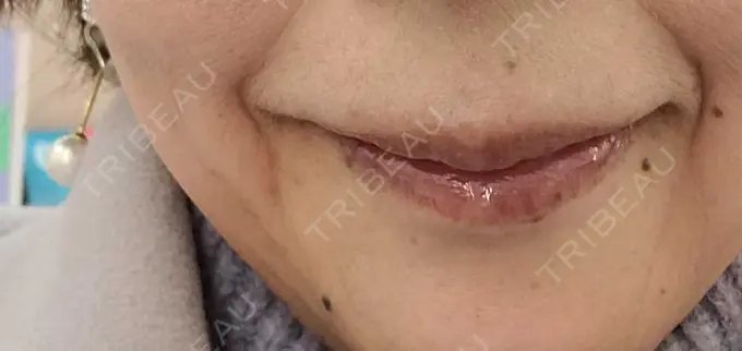 ヒアルロン酸注入（唇） / ボトックス（口角） ルラ美容クリニック 広島院 DAY 0 メイン用