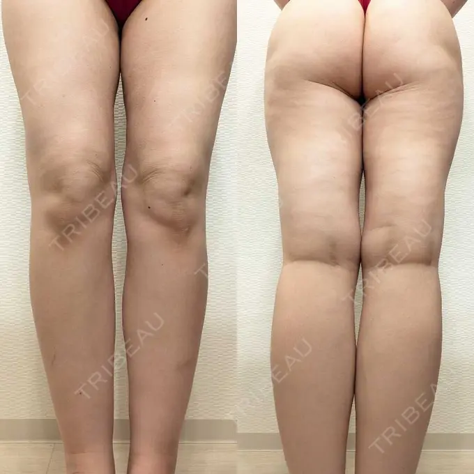 脂肪吸引（脚） / 脂肪吸引（お尻） / 豊胸（脂肪注入） Mods Clinic（モッズクリニック） 名古屋院 DAY 182 メイン用