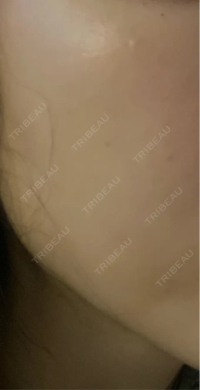 糸リフト / 脂肪吸引（顔） / 下まぶたの脂肪取り / 脂肪注入（目の下） 東京ココセランクリニック AFTER メイン用