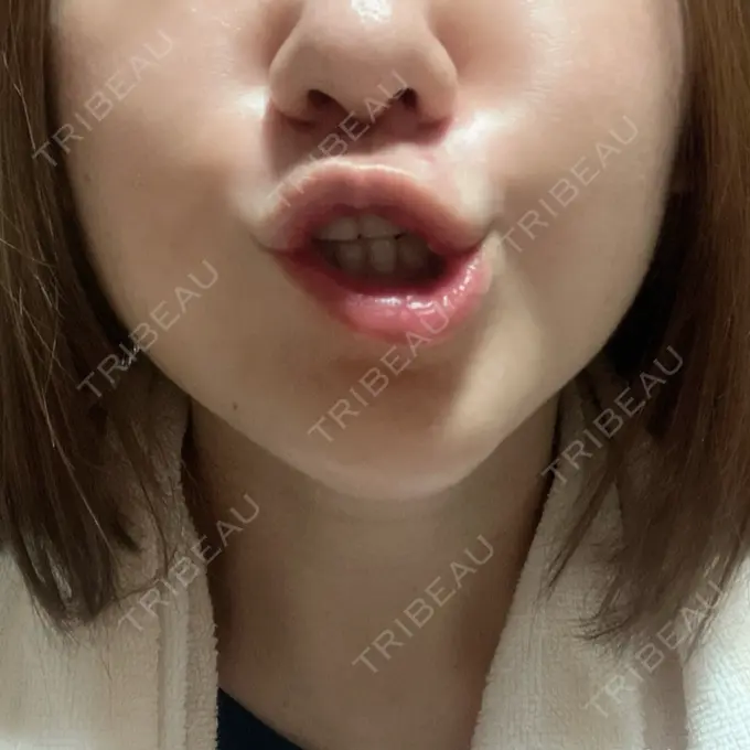 ボトックス（あご） / ボトックス（エラ・小顔） / ボトックス（口角） / シワ取りボトックス / ボトックス（眉間） 東京シルククリニック 新宿院 DAY 5 メイン用