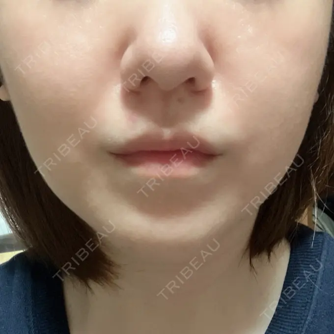 ボトックス（あご） / ボトックス（エラ・小顔） / ボトックス（口角） / シワ取りボトックス / ボトックス（眉間） 東京シルククリニック 新宿院 AFTER メイン用