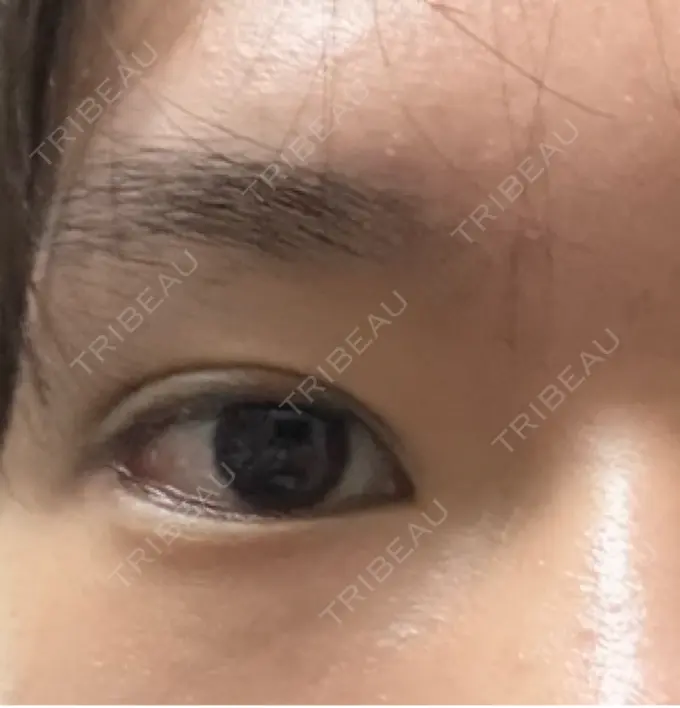 二重埋没 / 鼻尖形成（切開） / 口唇縮小術 / 目尻切開 / タレ目形成・グラマラスライン（切開） / 軟骨移植 / 眉間プロテーゼ アリエル美容クリニック 大宮院 DAY 68 メイン用