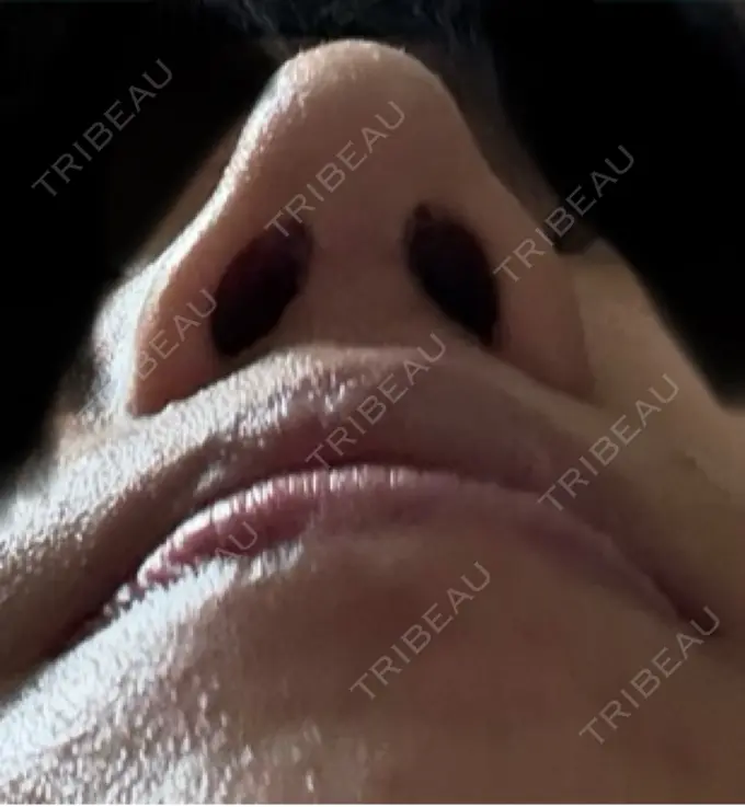 二重埋没 / 鼻尖形成（切開） / 口唇縮小術 / 目尻切開 / タレ目形成・グラマラスライン（切開） / 軟骨移植 / 眉間プロテーゼ アリエル美容クリニック 大宮院 DAY 68 メイン用