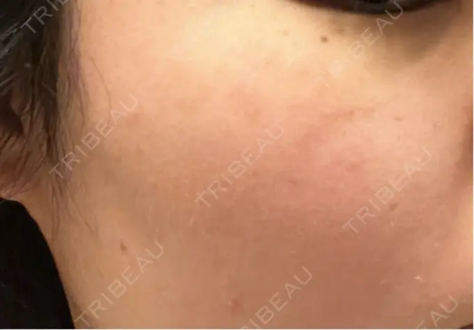 ピコスポット アマリラビューティークリニック DAY 10 メイン用