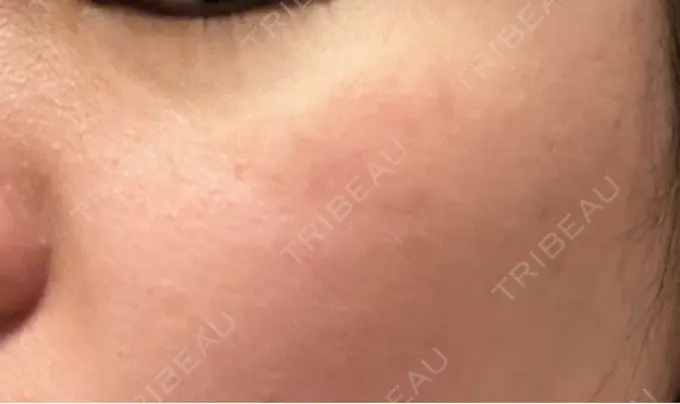 ピコスポット アマリラビューティークリニック DAY 10 メイン用