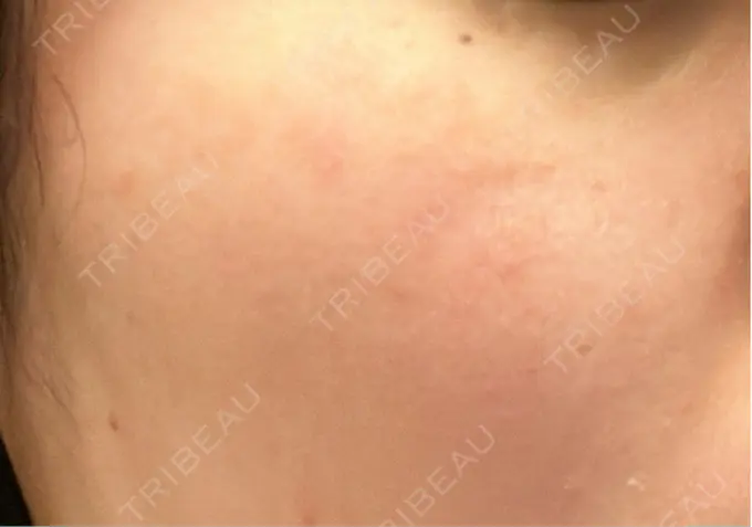 ピコスポット アマリラビューティークリニック AFTER メイン用