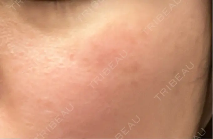 ピコスポット アマリラビューティークリニック DAY 11 メイン用