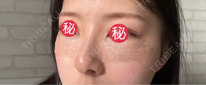 クマ治療 BIOTOPE CLINIC 【ビオトープクリニック】 DAY 1 メイン用