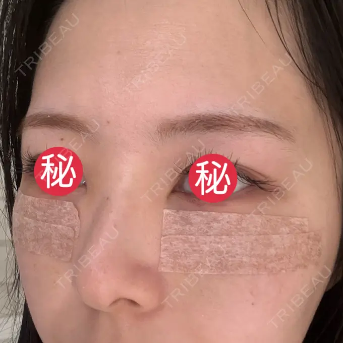 クマ治療 BIOTOPE CLINIC 【ビオトープクリニック】 DAY 2 メイン用