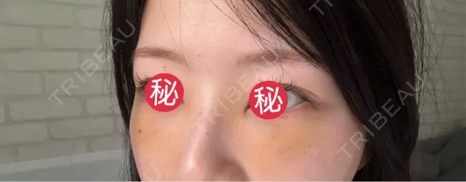 クマ治療 BIOTOPE CLINIC 【ビオトープクリニック】 DAY 3 メイン用