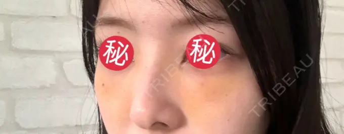 クマ治療 BIOTOPE CLINIC 【ビオトープクリニック】 DAY 3 メイン用