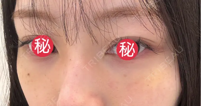 クマ治療 BIOTOPE CLINIC 【ビオトープクリニック】 DAY 7 メイン用