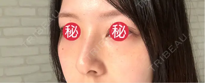 クマ治療 BIOTOPE CLINIC 【ビオトープクリニック】 DAY 8 メイン用