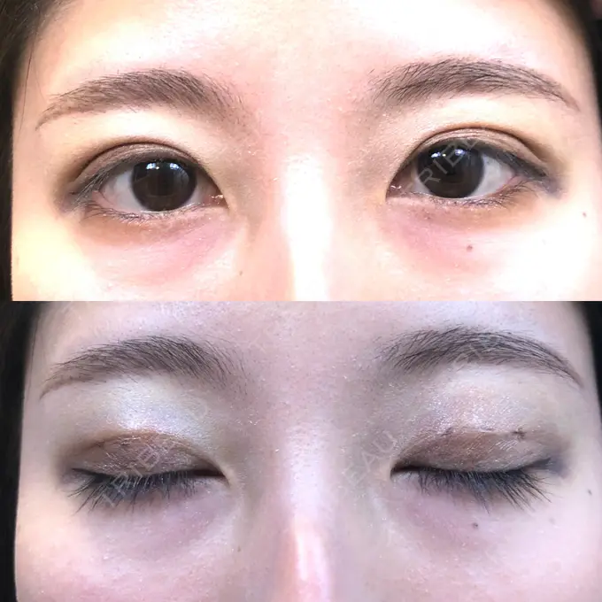 二重埋没 MIYAフェイスクリニック DAY 3 メイン用