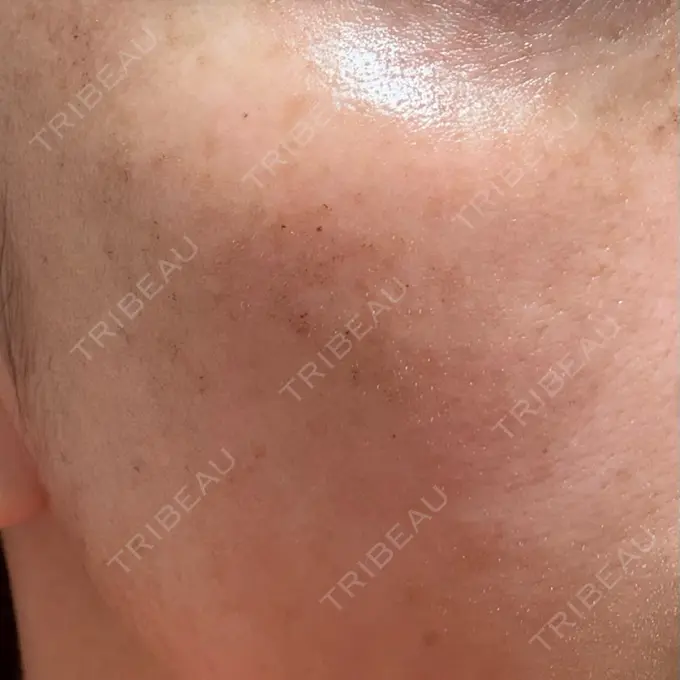 ルメッカ ルラ美容クリニック 広島院 DAY 1 メイン用