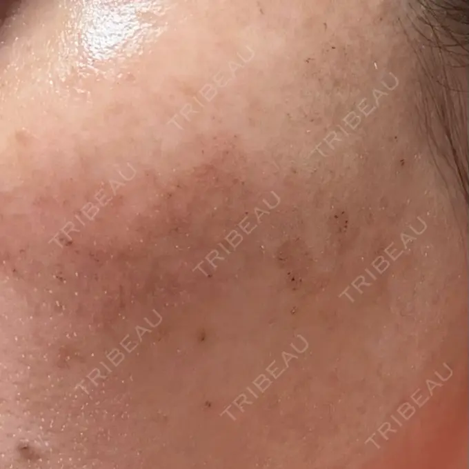 ルメッカ ルラ美容クリニック 広島院 DAY 1 メイン用