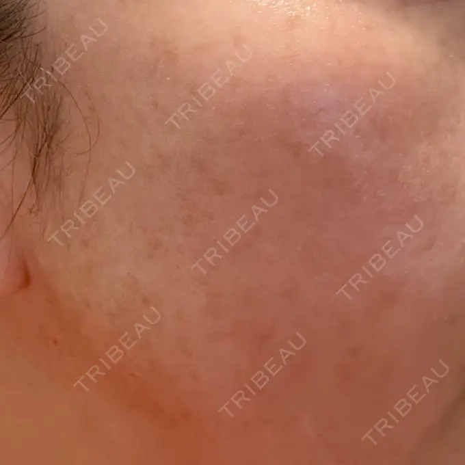 ルメッカ ルラ美容クリニック 広島院 AFTER メイン用