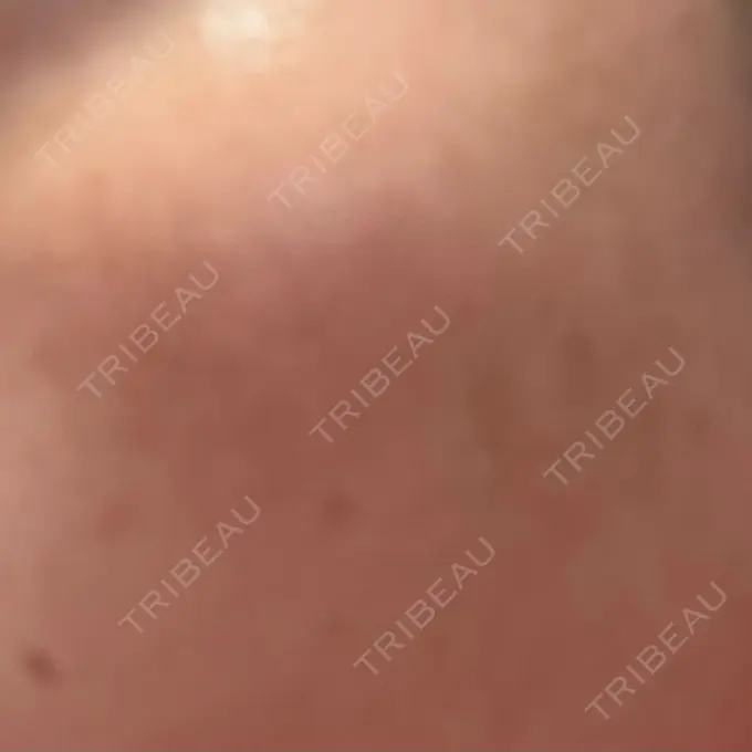 ルメッカ ルラ美容クリニック 広島院 DAY 21 メイン用