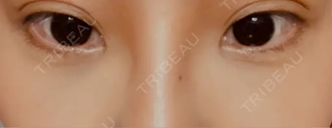 ヒアルロン酸溶解 麻布十番クレールデンタルクリニック AFTER メイン用