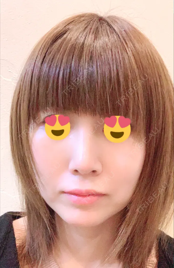 隆鼻術 / 鼻尖形成（切開） / 鼻中隔延長（切開） / 脂肪吸引（顔） / 軟骨移植 / プロテーゼ除去 / ヒアルロン酸注入（唇） ジュエリー美容外科 DAY 35 メイン用