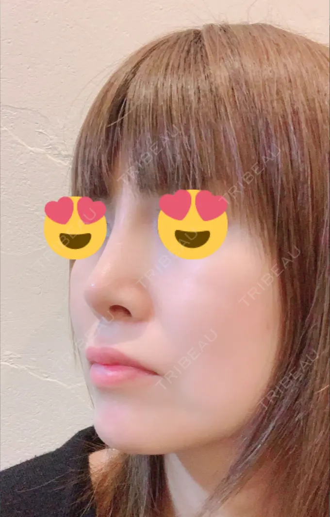隆鼻術 / 鼻尖形成（切開） / 鼻中隔延長（切開） / 脂肪吸引（顔） / 軟骨移植 / プロテーゼ除去 / ヒアルロン酸注入（唇） ジュエリー美容外科 DAY 35 メイン用