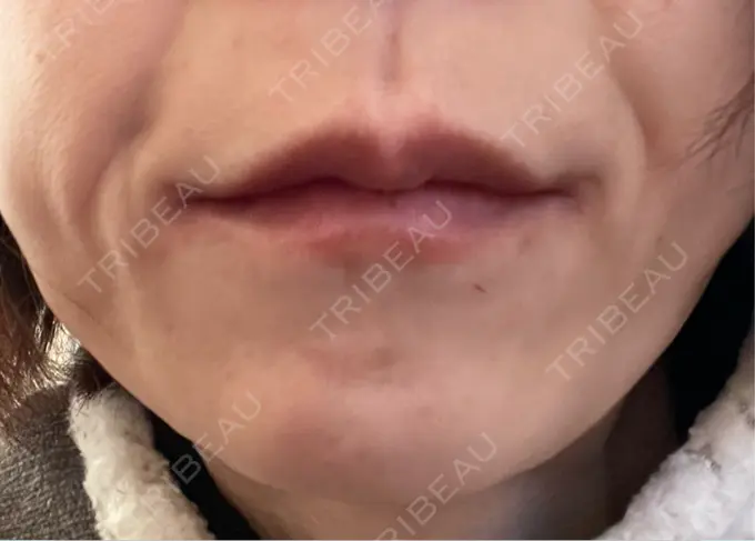 ボトックス（あご） TCB東京中央美容外科 神戸院 DAY 3 メイン用