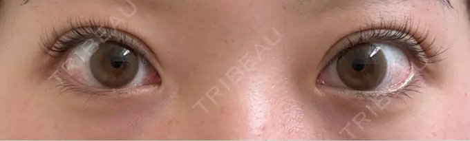 二重埋没 / 上まぶたたるみ取り 湘南美容クリニック 池袋東口院 AFTER メイン用