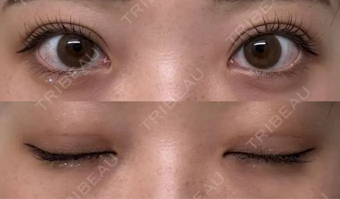 二重埋没 / 上まぶたたるみ取り 湘南美容クリニック 池袋東口院 DAY 31 メイン用