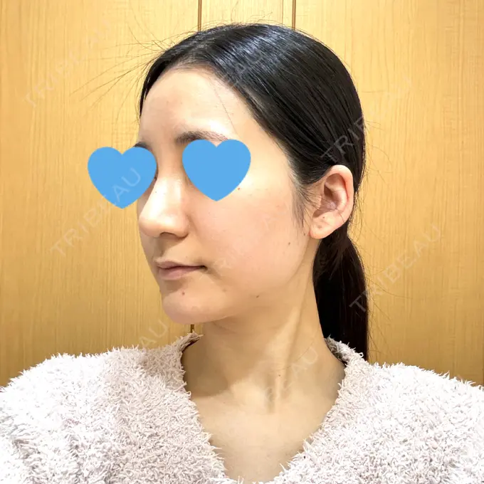 鼻尖形成（切開） / 鼻中隔延長（切開） / 軟骨移植 / 骨切幅寄せ / ワシ鼻修正・ハンプ切除 WOM CLINIC GINZA （ワム クリニック ギンザ） DAY 40 メイン用