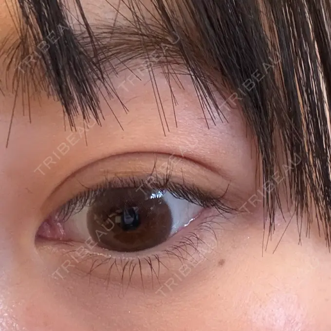 二重埋没 高須クリニック 名古屋院 AFTER メイン用