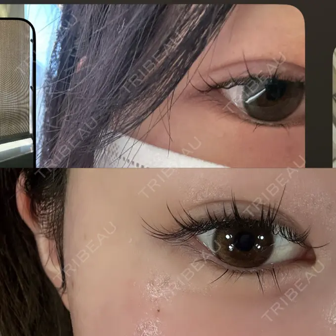 ヒアルロン酸注入（涙袋） AZ BEAUTY CLINIC AFTER メイン用