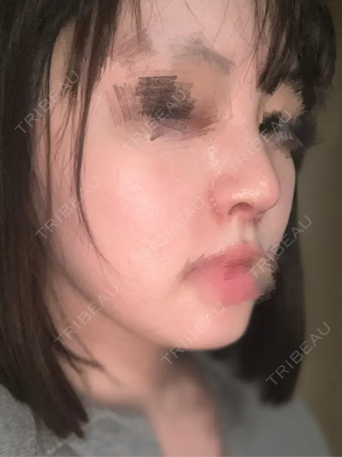 隆鼻術 / 鼻尖形成（切開） / 鼻中隔延長（切開） / 軟骨移植 / 鼻孔縁挙上 / 鼻孔縁下降 / 鼻翼基部形成（貴族手術） / その他（鼻） Designo Clinic （デジーノクリニック） DAY 12 メイン用