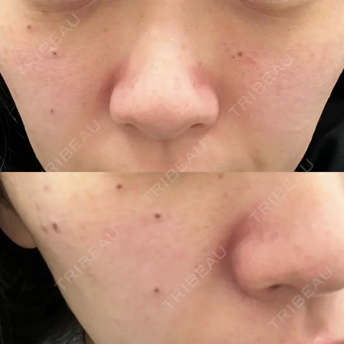 イオン導入 / 毛穴洗浄（ハイドラフェイシャルなど） / ルメッカ ルラ美容クリニック 大宮院 / ルラスキンクリニック 大宮院 DAY 0 メイン用