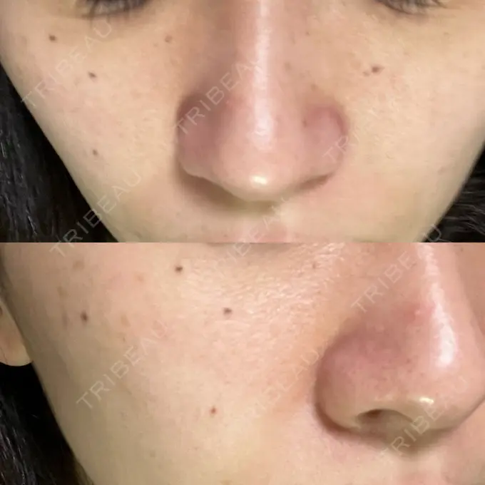 イオン導入 / 毛穴洗浄（ハイドラフェイシャルなど） / ルメッカ ルラ美容クリニック 大宮院 / ルラスキンクリニック 大宮院 AFTER メイン用