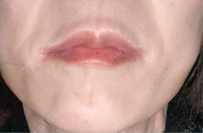 ボトックス（あご） TCB東京中央美容外科 神戸院 DAY 4 メイン用