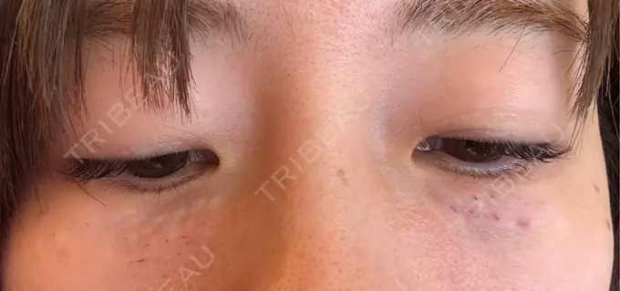 肌育注射（ジュベルックなど） APスキンクリニック銀座 DAY 0 メイン用