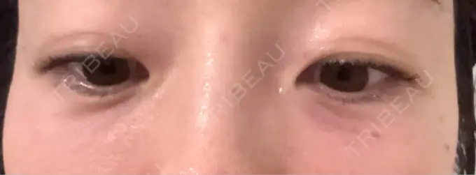 肌育注射（ジュベルックなど） APスキンクリニック銀座 DAY 1 メイン用