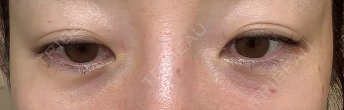 肌育注射（ジュベルックなど） APスキンクリニック銀座 DAY 3 メイン用