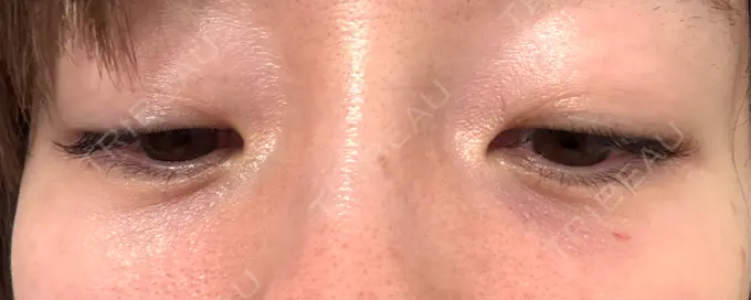 肌育注射（ジュベルックなど） APスキンクリニック銀座 AFTER メイン用